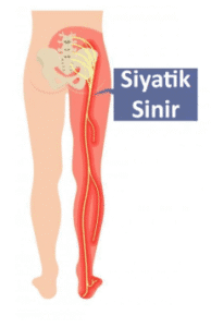 ozon tedavisi siyatik sinir ağrısında çok iyi sonuç verir